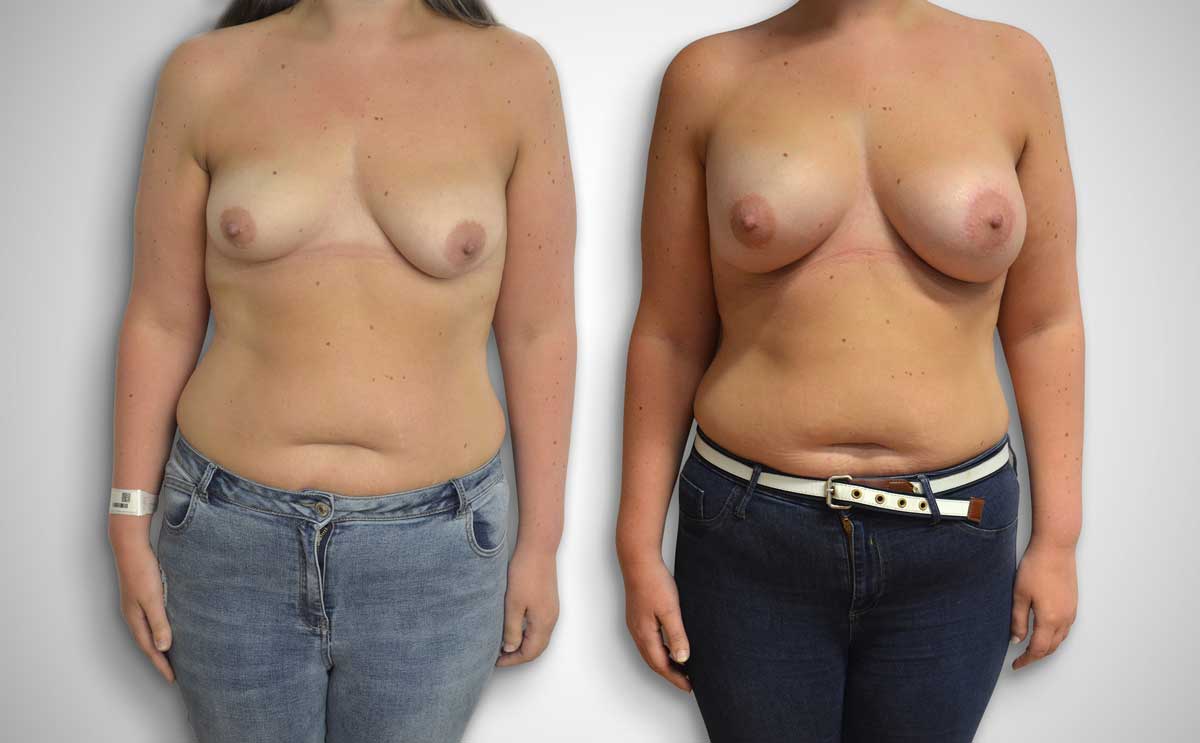 Breast Asymmetry Correction - Russell Bramhall