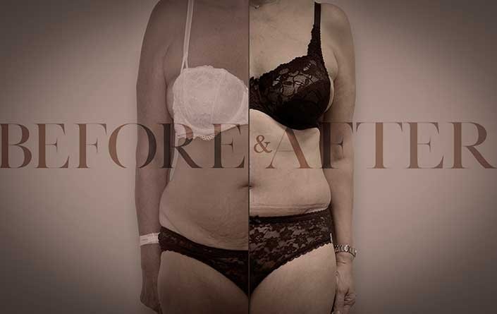 tummy-tuck-patient-front1