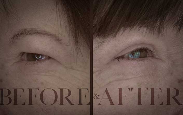 Bilateral-upper-eyelid-surgery-patient-2-corner-DS