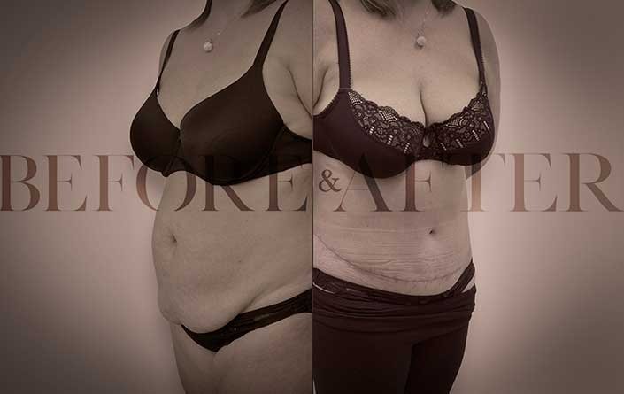 breast-reduction-corner1