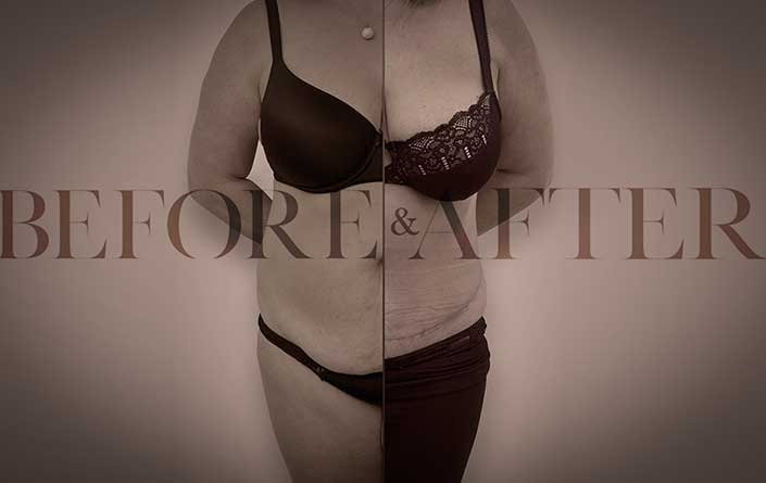 breast-reduction-front1
