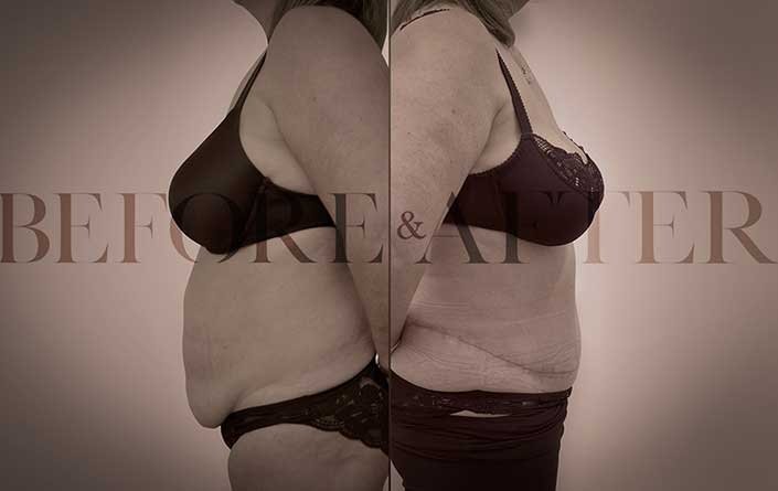 breast-reduction-side1