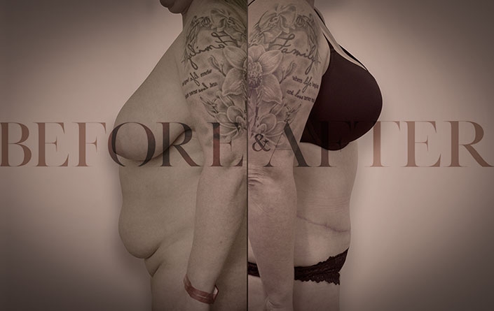breast-reduction-side1