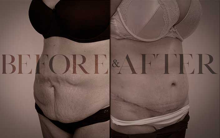 tummy-tuck-LG-S1