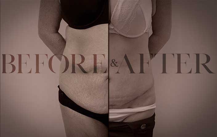 tummy-tuck-LG-S3