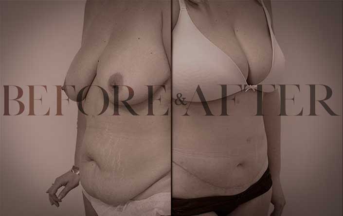 tummy-tuck-LL-S1