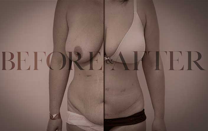 tummy-tuck-LL-S3