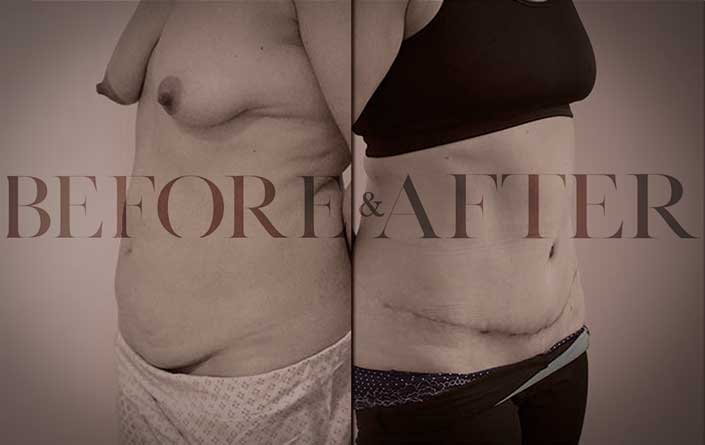 tummy-tuck-PJ-S1