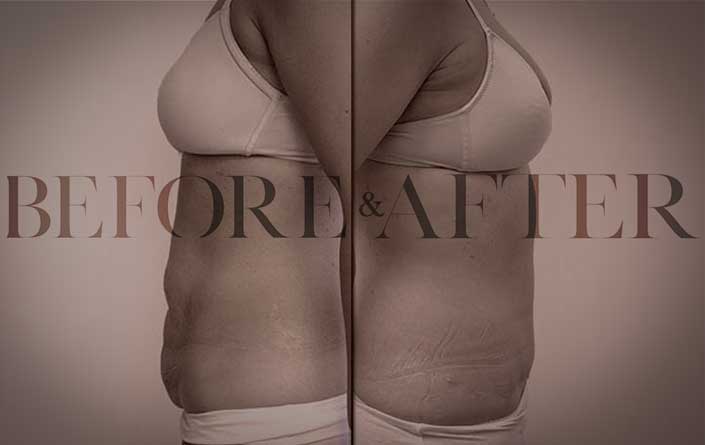 tummy-tuck-TF-S1