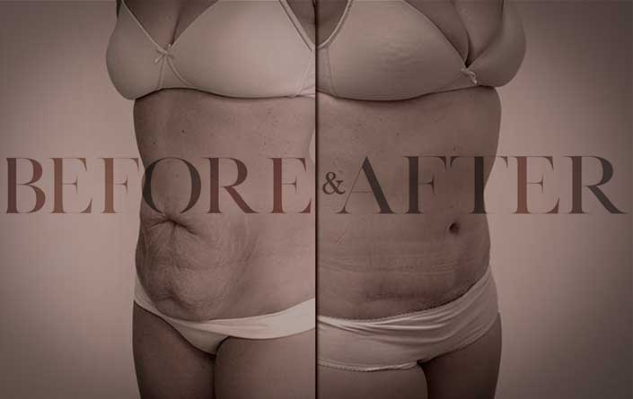 tummy-tuck-TF-S3