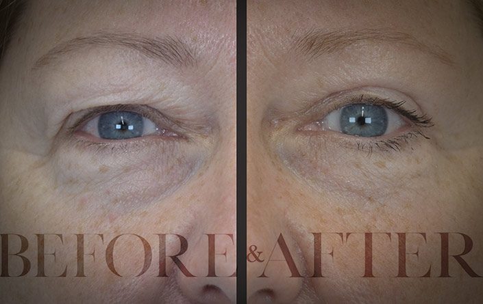 Blepharoplasty-Patient-18-Front