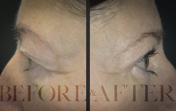 Blepharoplasty-Patient-22-Side