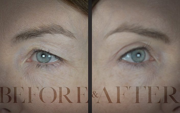 Blepharoplasty-Patient-26-Corner