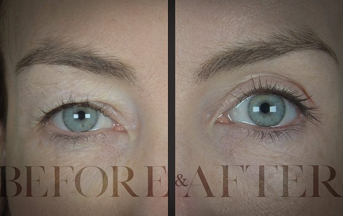 Blepharoplasty-Patient-26-Front
