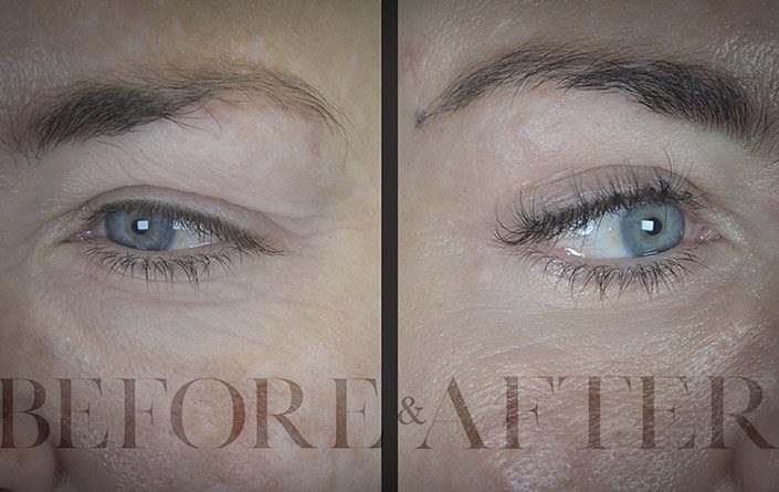 Blepharoplasty-Patient-35-Corner