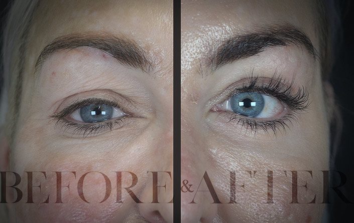 Blepharoplasty-Patient-35-Front
