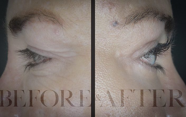 Blepharoplasty-Patient-35-Side