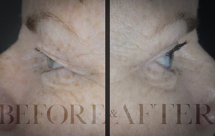 Blepharoplasty-Patient-45-Side