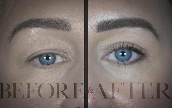 Blepharoplasty-Patient-46-Front