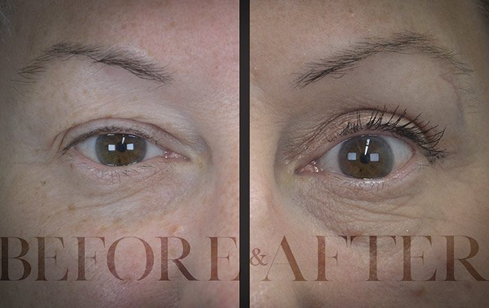 Blepharoplasty-Patient-47-Front