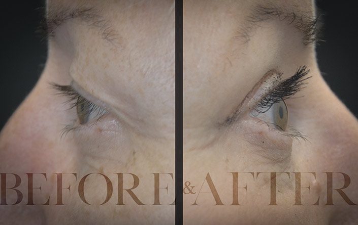 Blepharoplasty-Patient-47-Side