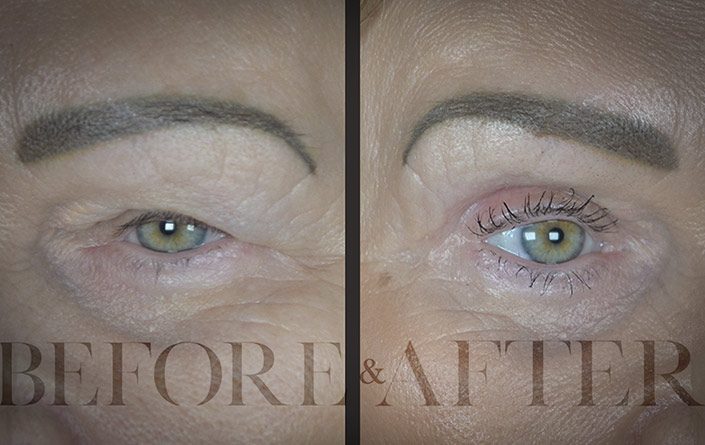 Blepharoplasty-Patient-49-Corner