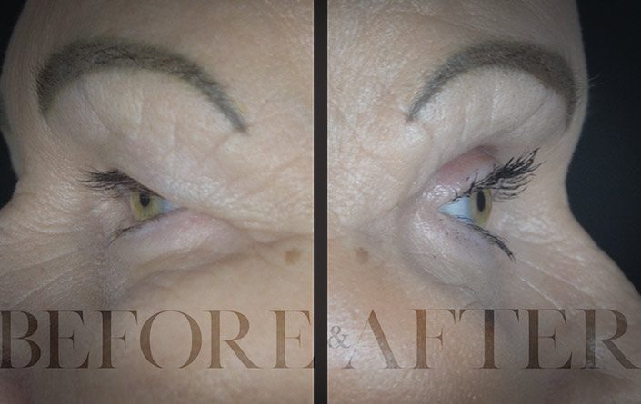 Blepharoplasty-Patient-49-Side