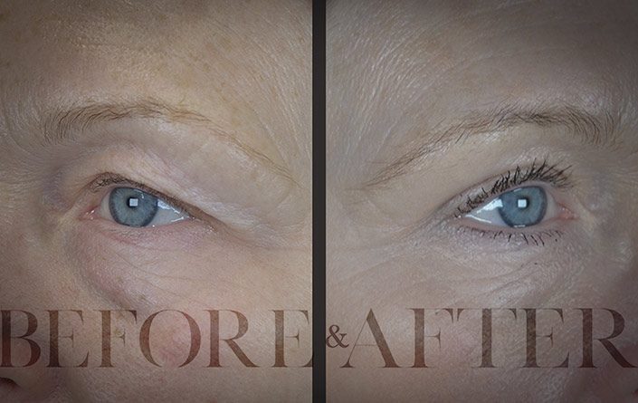 Blepharoplasty-Patient-9-Corner