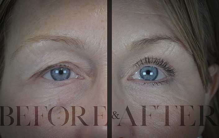 Blepharoplasty-Patient-9-Front