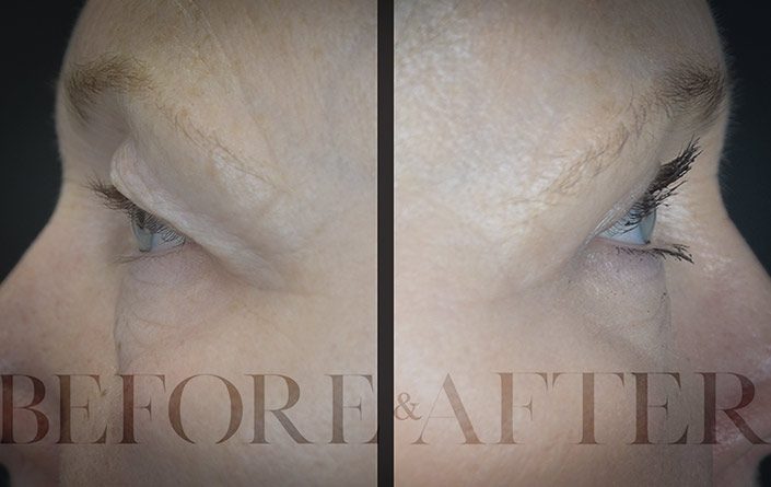 Blepharoplasty-Patient-9-Side