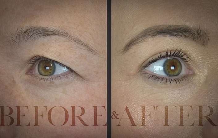 Blepharoplasty-Patient-Corner