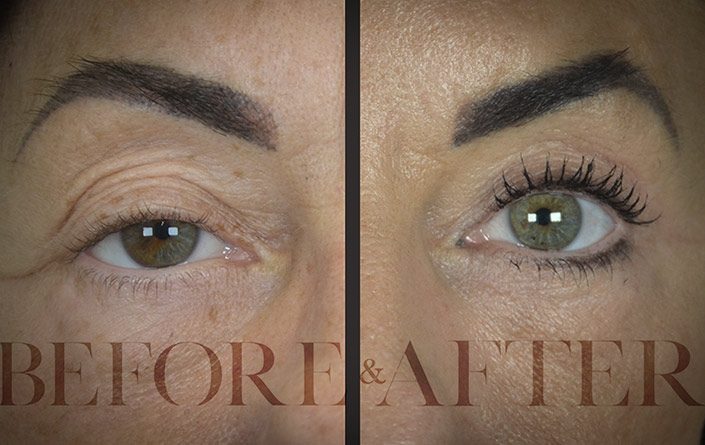 Blepharoplasty-Patient–Front