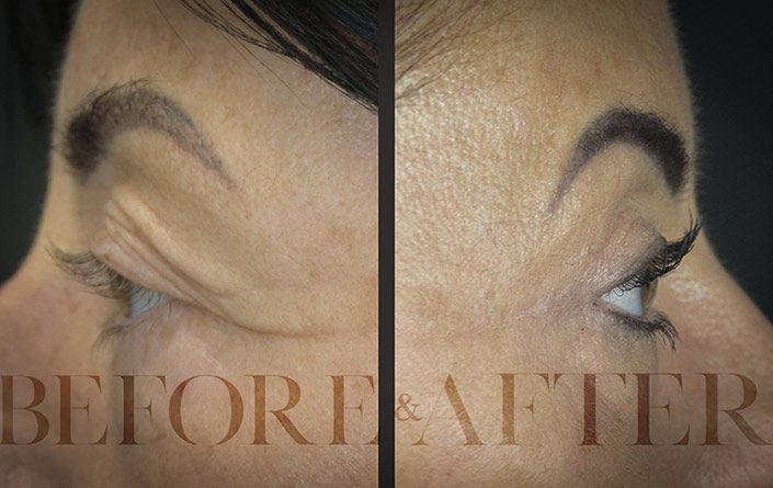 Blepharoplasty-Patient–Side