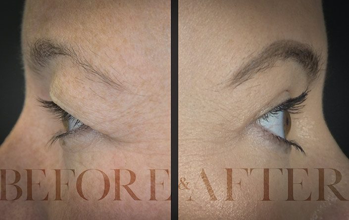 Blepharoplasty-Patient-Side