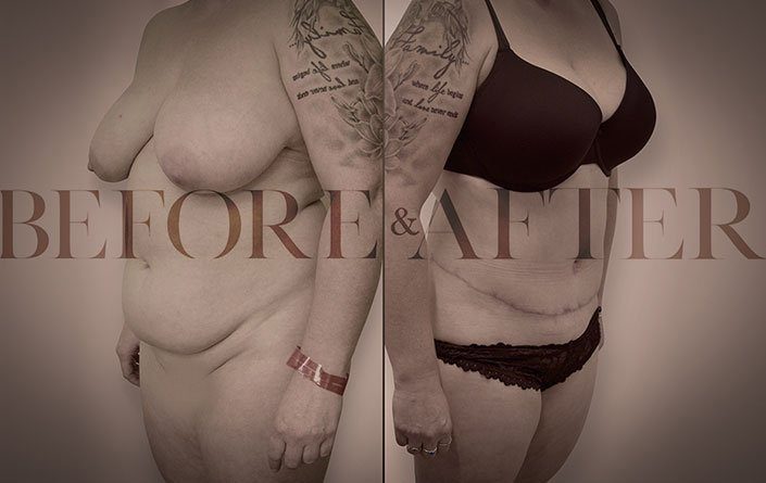 breast-reduction-corner1