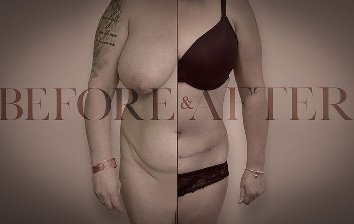 breast-reduction-front1