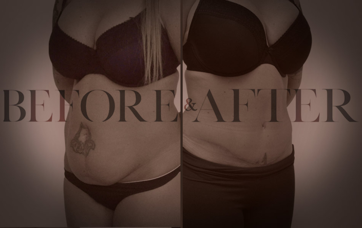 patient-13-abdominoplasty-Corner