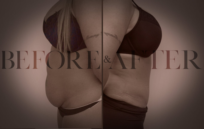 patient-13-abdominoplasty-Side