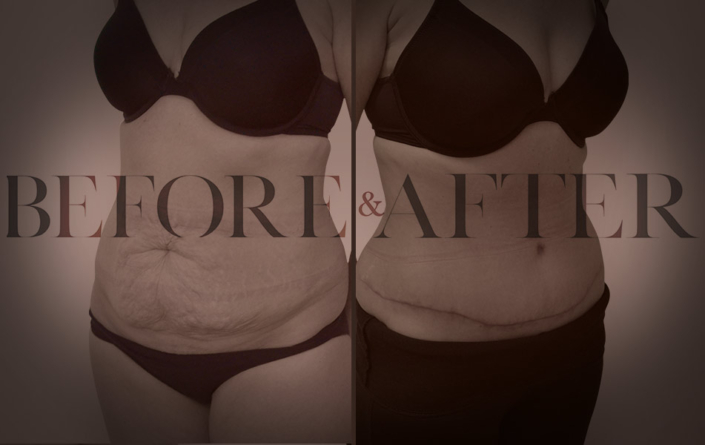 patient-20-abdominoplasty-Corner