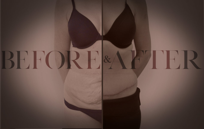 patient-20-abdominoplasty-Front