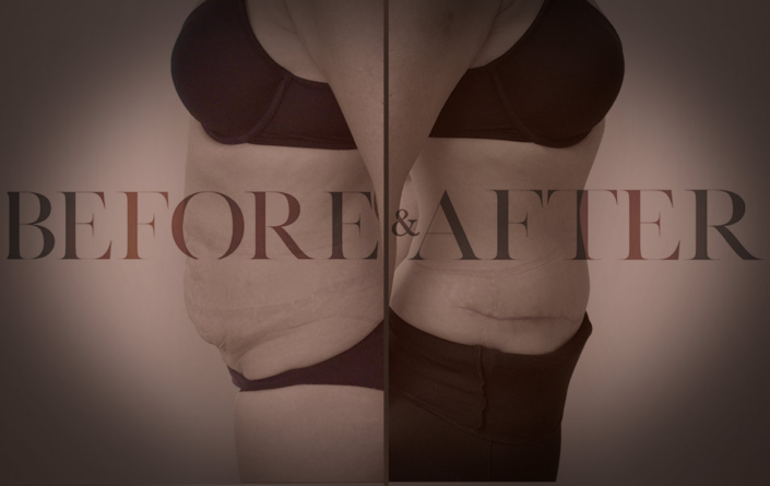 patient-20-abdominoplasty-Side