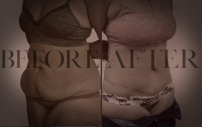 patient-36-tummy-tuck-Corner