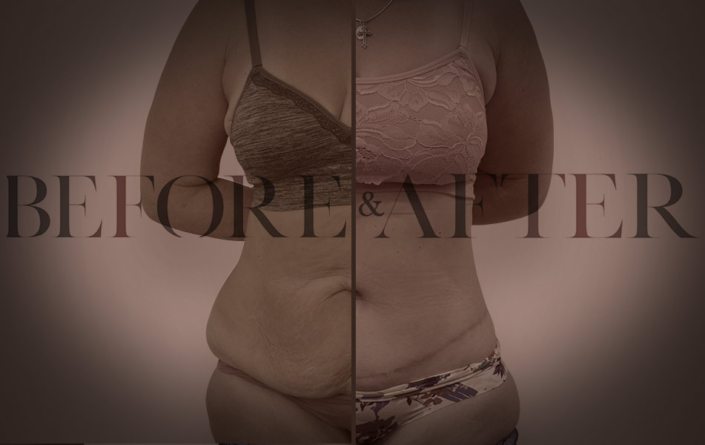 patient-36-tummy-tuck-Front